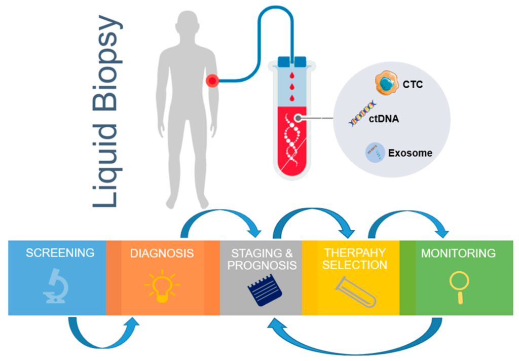 Liquid Biopsy: A Promising Tool for Prostate Cancer Screening