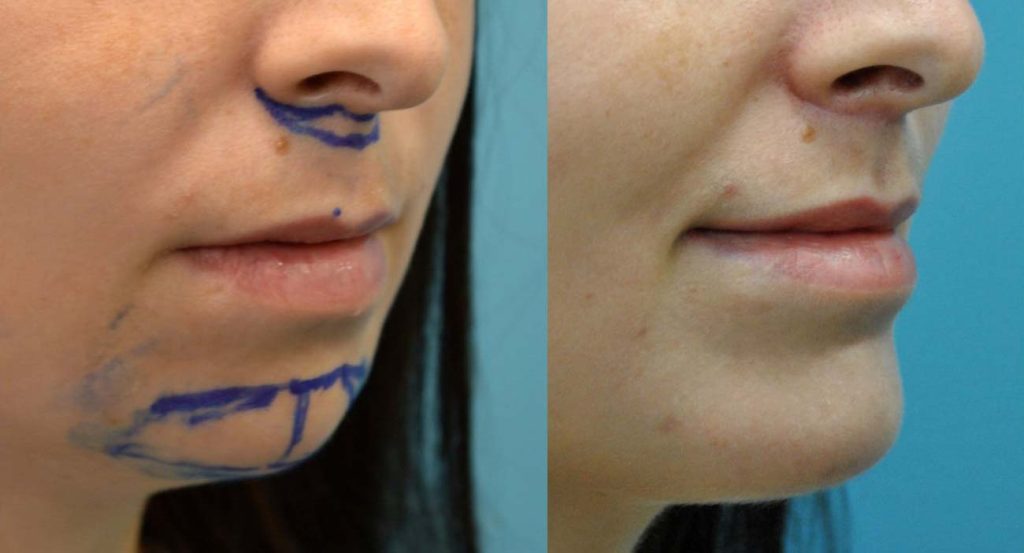 lip shortening before and after