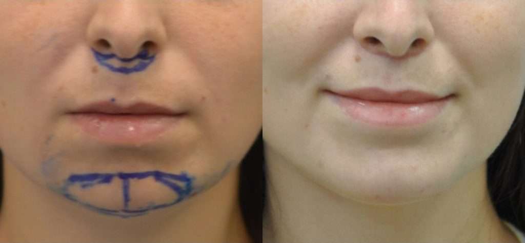 chin implant before and after