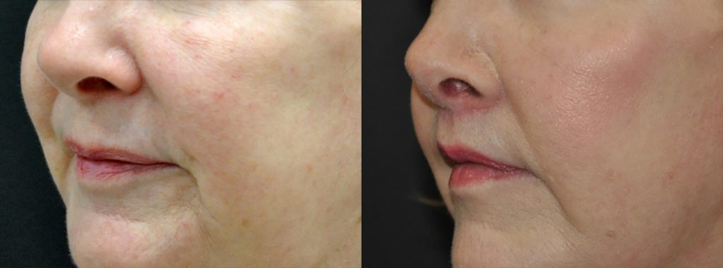 lip lift before and after 64 years old woman