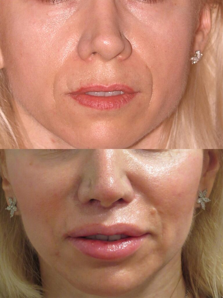 lip lift before and after