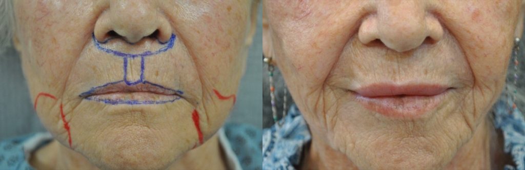 61 years old lady lip reduction surgery before and after